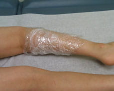 EMLA cream applied to calf muscle with plastic wrap covering.